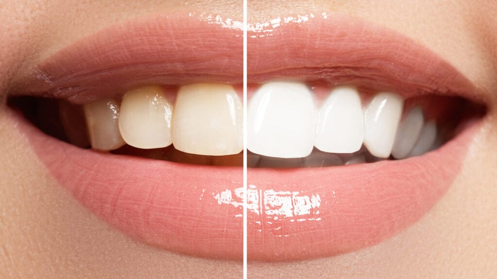 teeth whitening proof